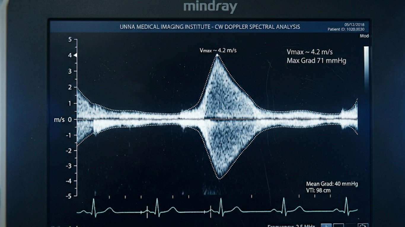Vaginaler Ultraschall — Endometrium im Sagittalschnitt des Uterus